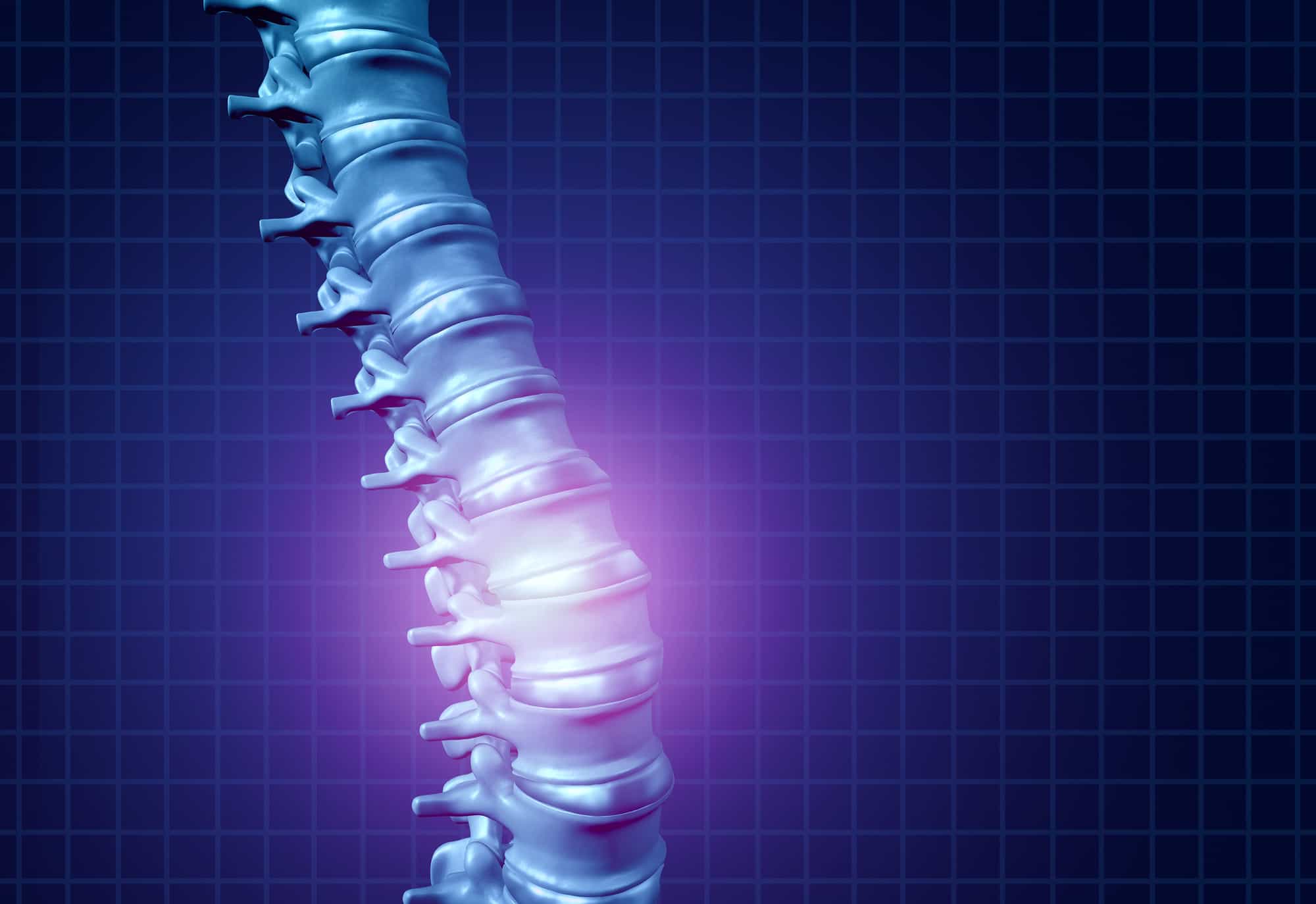 Abnormal Posture and Spinal Alignment Increases Degeneration