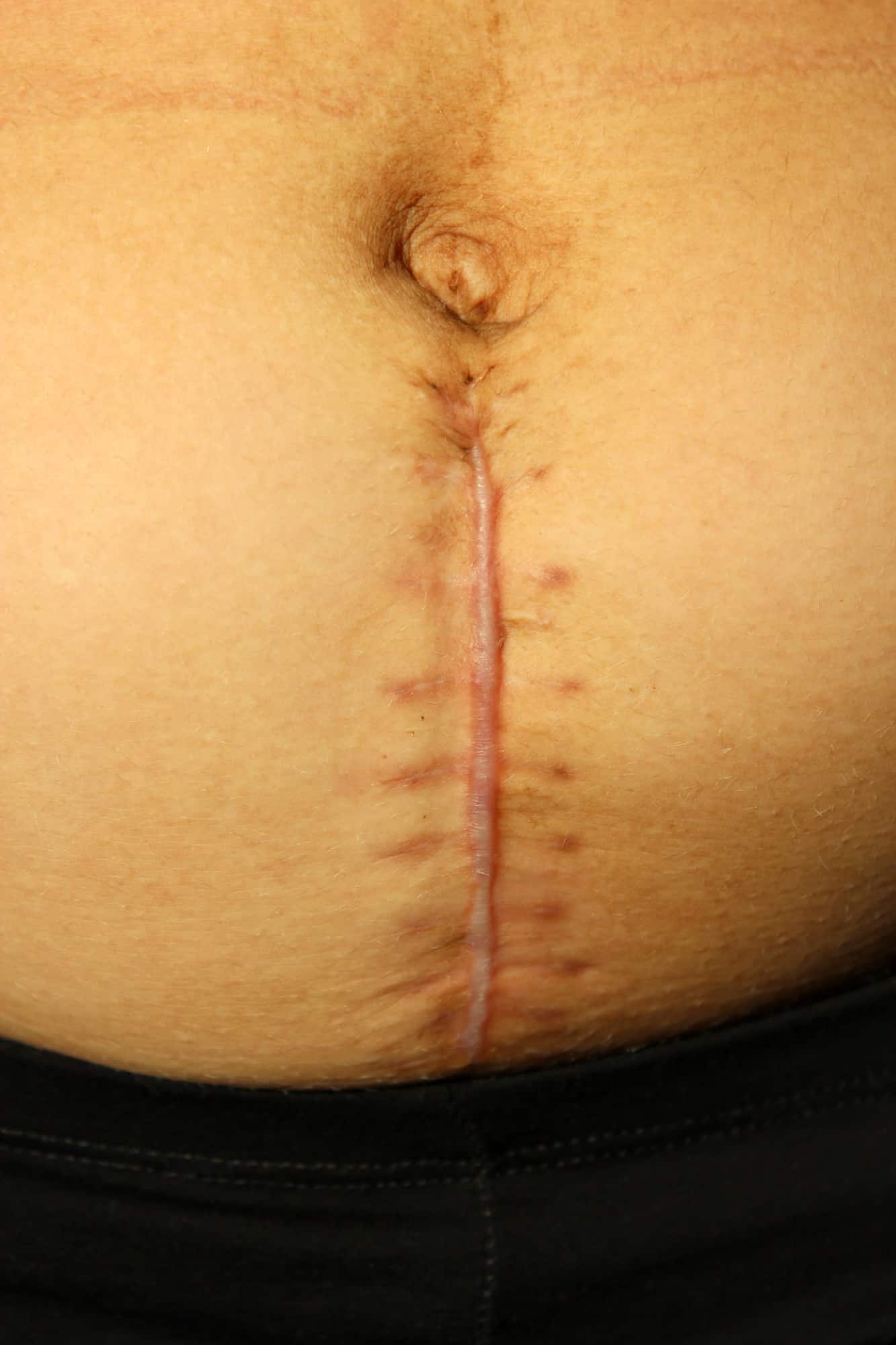 seams after the operation of C-section