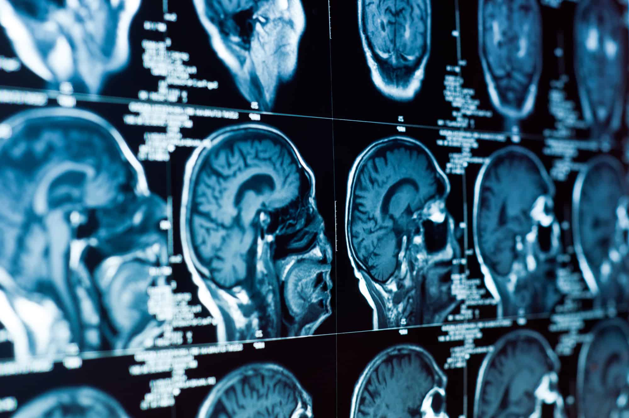 MRI Scan shows Adjustments Reduce Pain and Improve Brain Chemistry