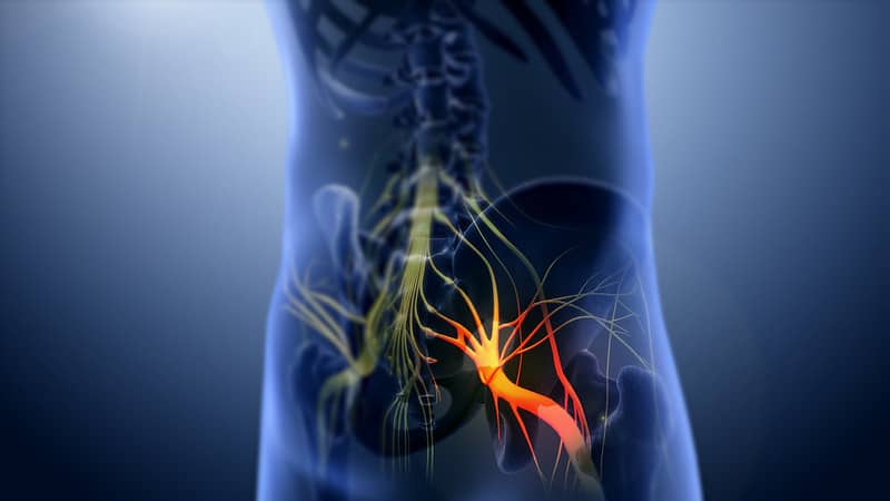 A Natural Solution for Sciatica: Chiropractic Care