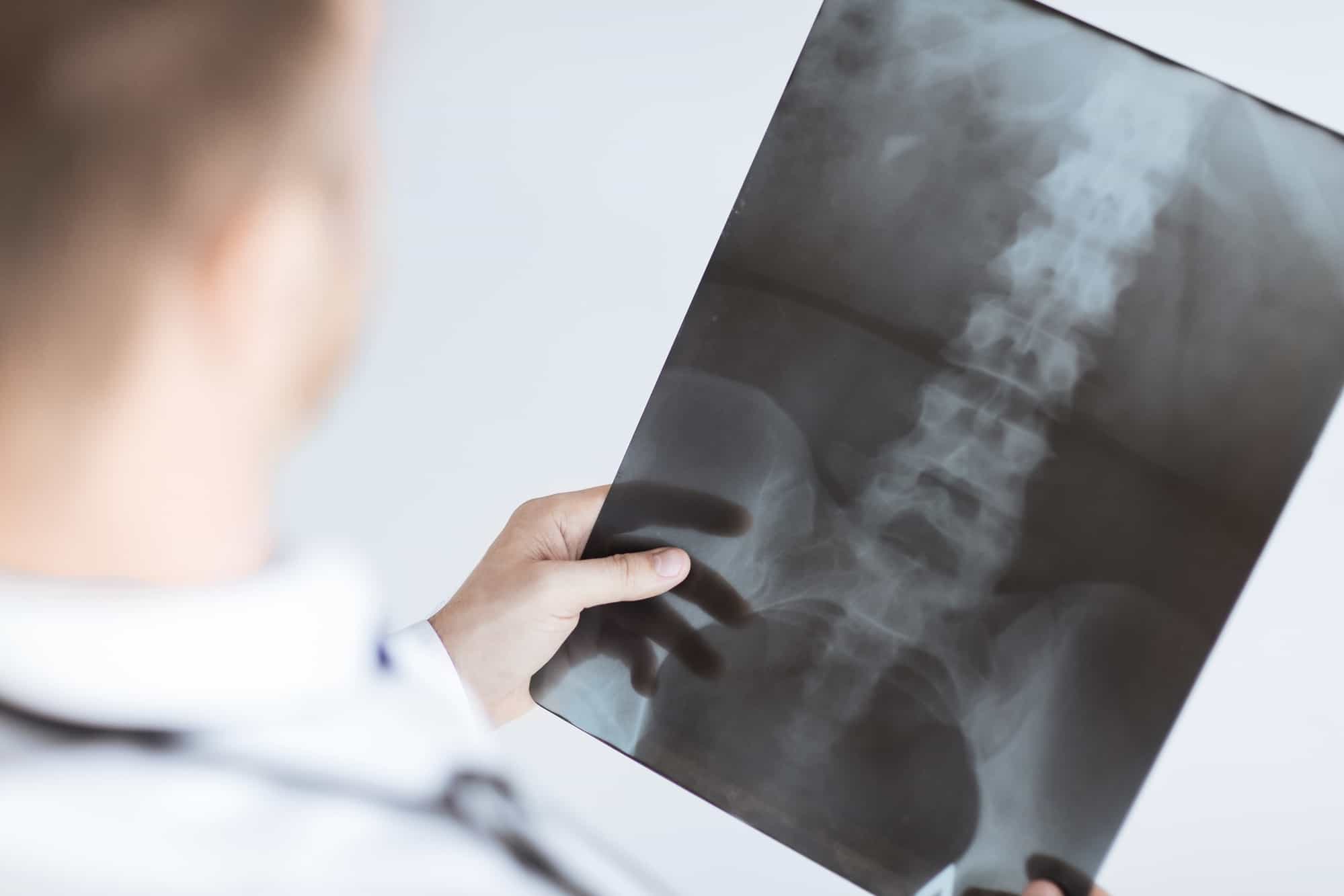 A chiropractor is holding an x-ray result depicting a misaligned spine